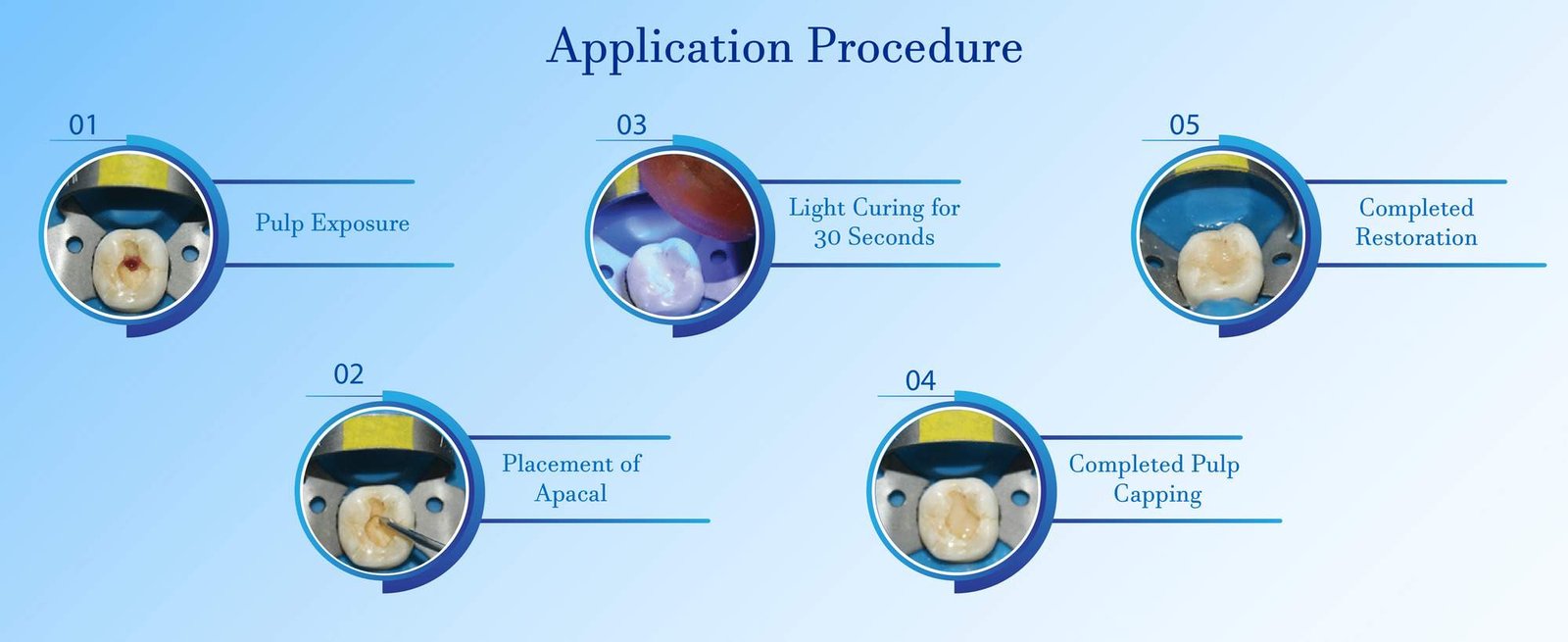 resin modified calcium hydroxide cement