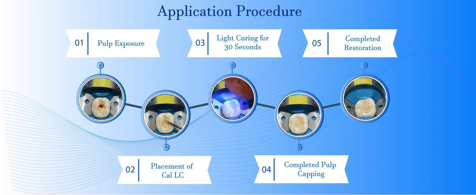Light cure calcium hydroxide cement