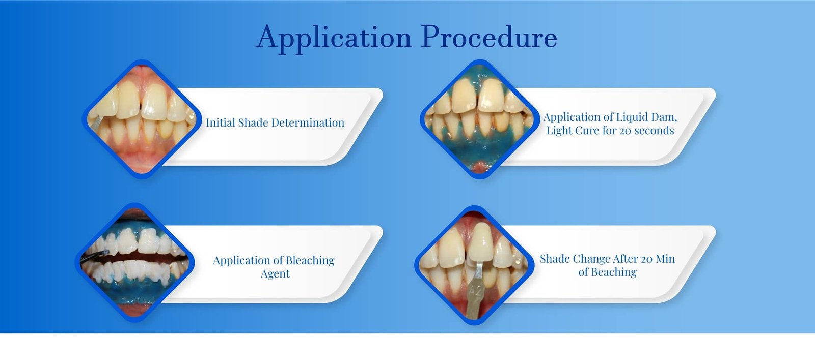 In office teeth whitening system