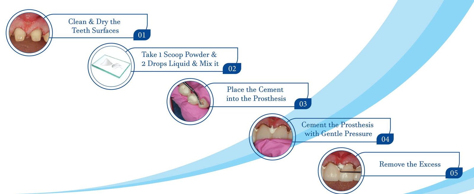 type 2 luting glass ionomer cement
