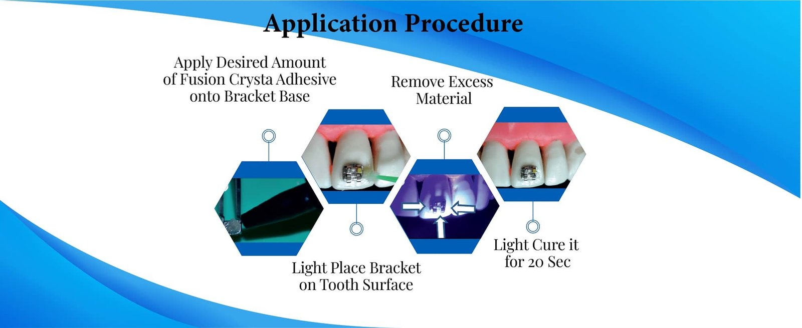 Orthodontic Adhesive