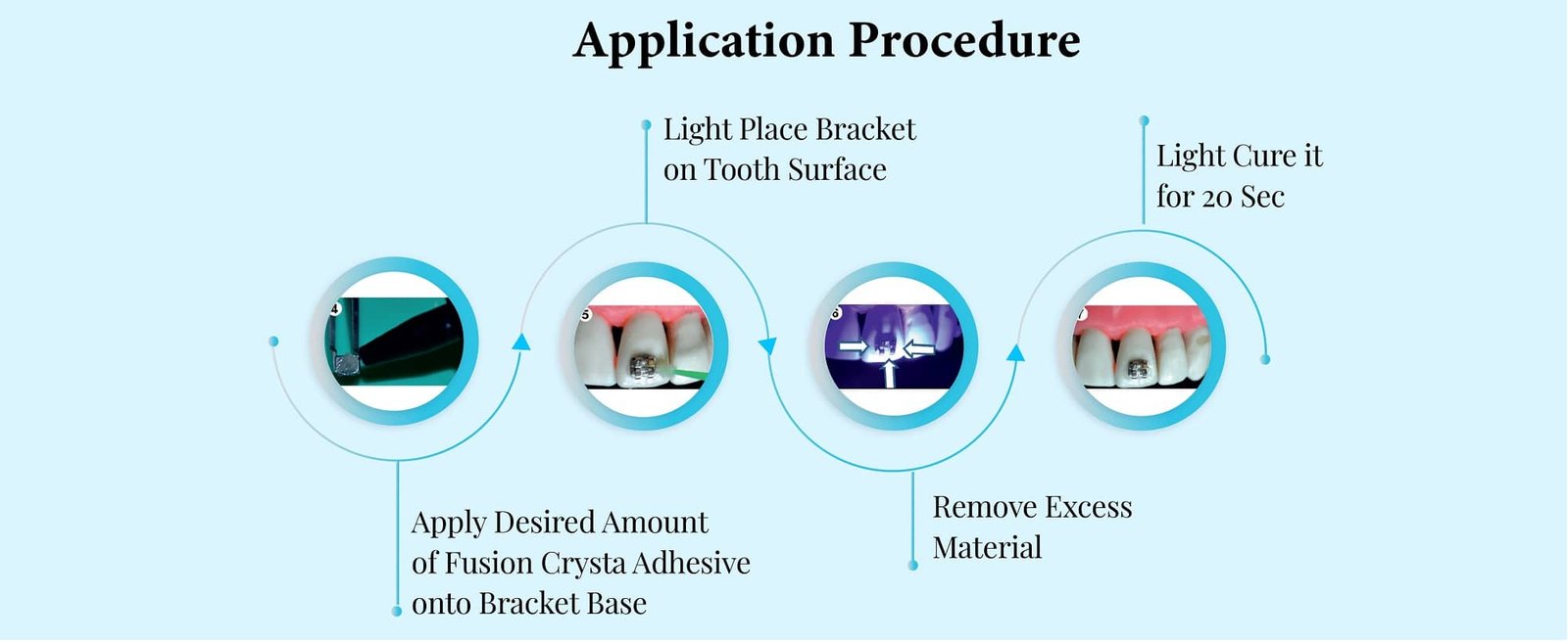 orthodontic adhesive kit