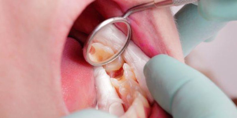 calcium hydroxide cement